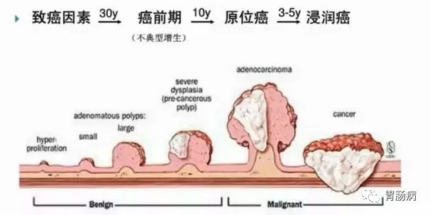 體檢查出腸息肉一定要切除！ 95%腸癌由它演變而來(lái)