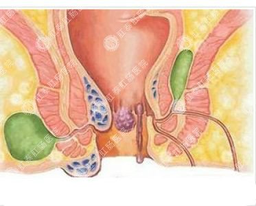 南寧哪個(gè)醫院可以做肛周膿腫？