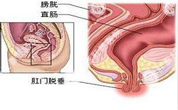 南寧治療脫肛哪家醫院好？南寧脫肛治療多少錢(qián)？